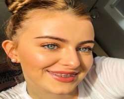 Bonnie has used braces to correct her teeth.